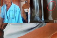 Foto kolase: Subiyat (baju biru) bersama anaknya, usai buat laporan ke Polsek Karangrayung. Foto lain hasil rontgen (x-ray) RSUD Purwodadi.