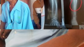 Foto kolase: Subiyat (baju biru) bersama anaknya, usai buat laporan ke Polsek Karangrayung. Foto lain hasil rontgen (x-ray) RSUD Purwodadi.