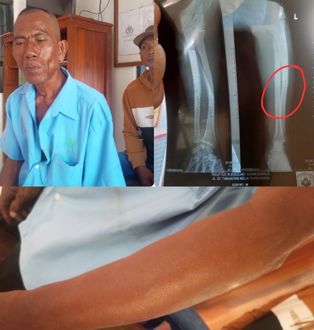 Foto kolase: Subiyat (baju biru) bersama anaknya, usai buat laporan ke Polsek Karangrayung. Foto lain hasil rontgen (x-ray) RSUD Purwodadi.